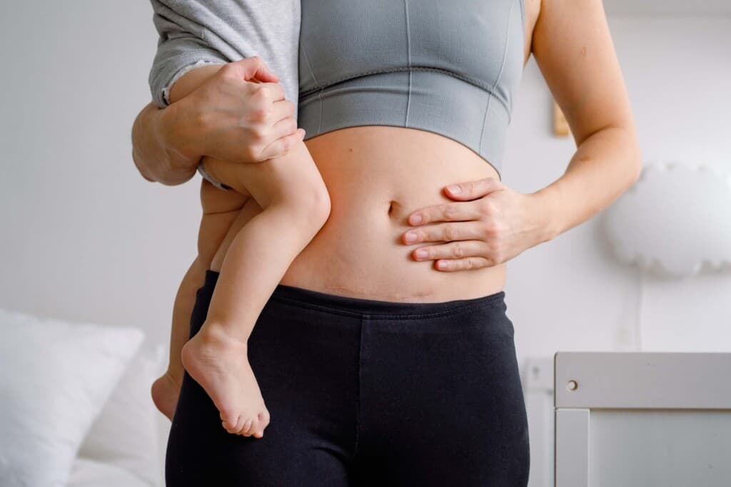 Burn Injury Lawyer In Ohio